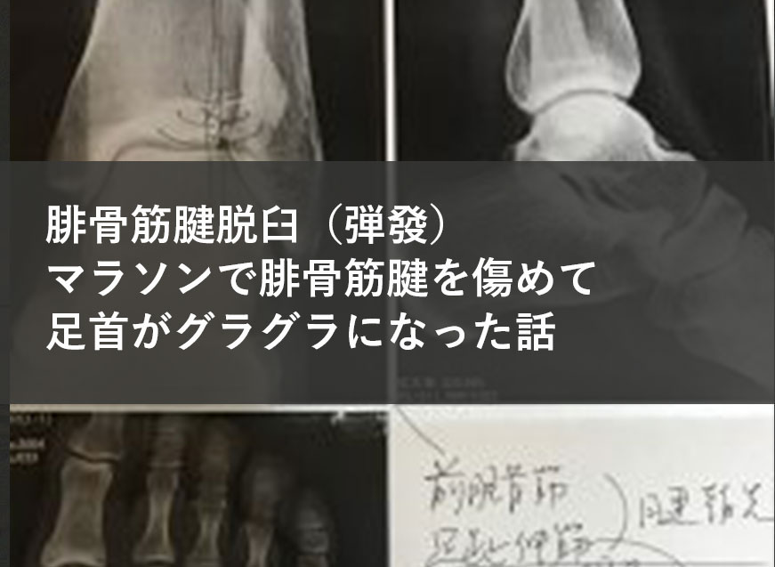 腓骨筋腱脱臼 弾發 マラソンで腓骨筋腱を傷めて足首がグラグラになった話 Monotame